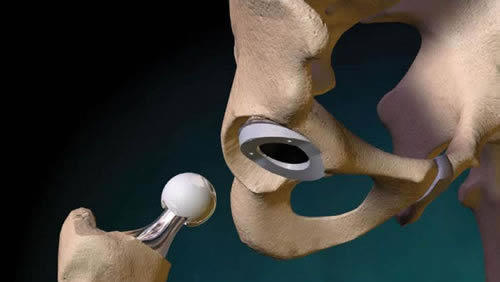 kalça protezi neden takılır