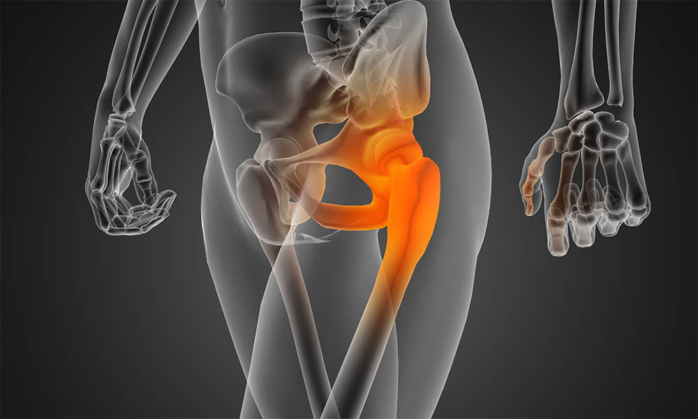 Kalça Osteoartriti Nedir?